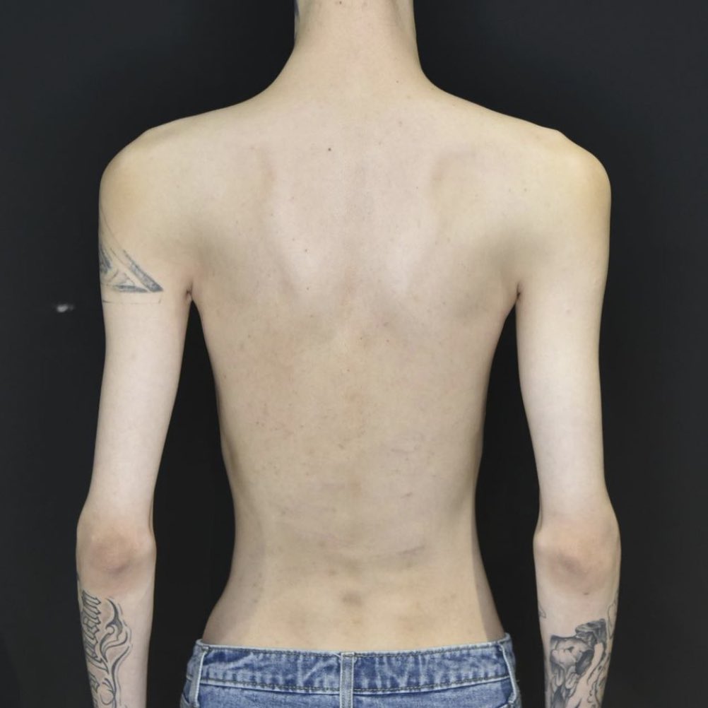 edenkcaI's tweet photo. 187cm/45kg
bmi 12.9 https://t.co/CEvXeGH4ns