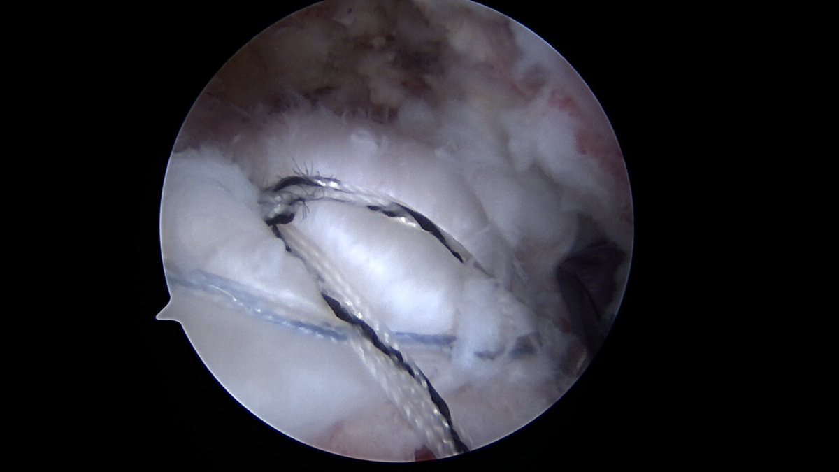 Shoulder pain? Here’s a rotator cuff tear, before, during, and after fixation! #shoulder #cuff #rotatorcuff #MOI #sports #arthroscopicsurgery #shoulderpain #fix #orthotwitter #docsoftwitter #surgeon #surgery #doublerow