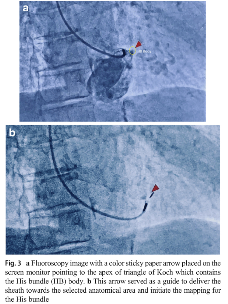 JICE_EP's tweet photo. 🚨 Hot off the press: The overall acute success of inserting the lead at the HB was 95% by localizing the apex of the triangle of Koch/HB body with the RA septogram⬇️⬇️⬇️
https://t.co/tQvJBfeJ3x
#Hisbundle #dontdisthehis #EPeeps #CardioTwitter #MedTwitter https://t.co/WnGaeCHSi3