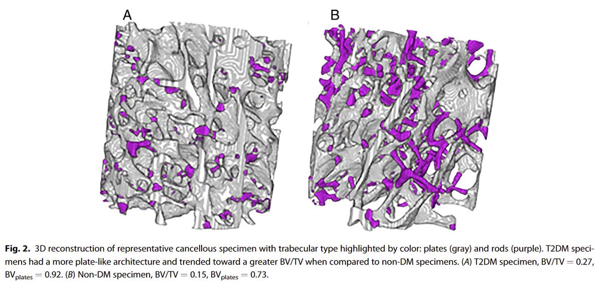 Analysis of cancellous bone from Type 2 Diabetic patients by <a href="/ORSsociety/">Orthopaedic Research Society</a> members revealed more plate-like architecture in T2D compared to non-diabetics, but damage accumulation did not differ with disease. Read more of the <a href="/DonnellyLab/">Donnelly Lab</a>'s new work:
ow.ly/RxEj50I0C4B
#ORSSMC