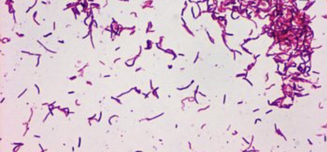 IUIDfellowship's tweet photo. #IdBoardReview Pt w/ cirrhosis splinter injury to finger from citrus tree 1 wk ago now/ fever, diffuse rash, arthralgia. Blood cultures w/gram+rods. Dx? #meded #idmeded #idtwitter https://t.co/ocvyshPOsQ