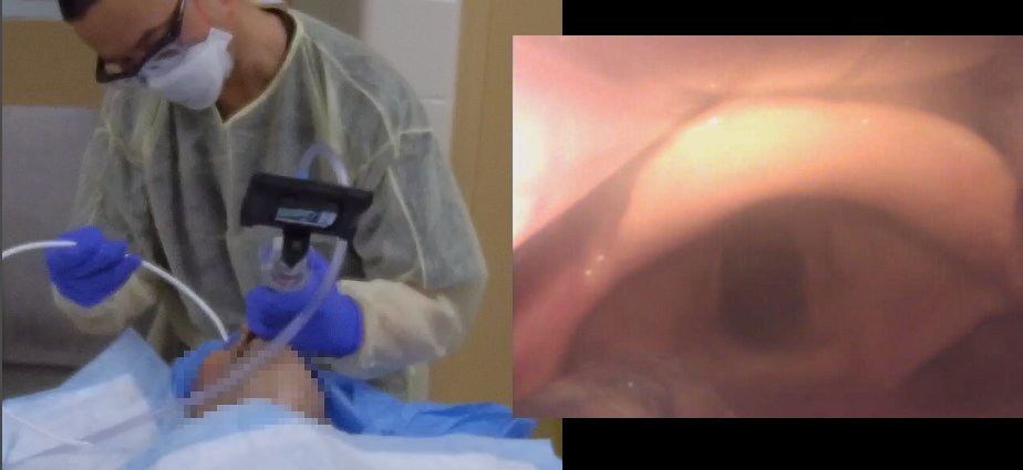 Same airway, cadaver lab, SGVL superior optimal VL view with black tracheal hole sign, <=2/3 POGO, epiglottis visible far off view, larynx <=50% of screen, lots of tube delivery space, minimal lift on glottic structures, not to mention tongue primary curve flattening by SG blade