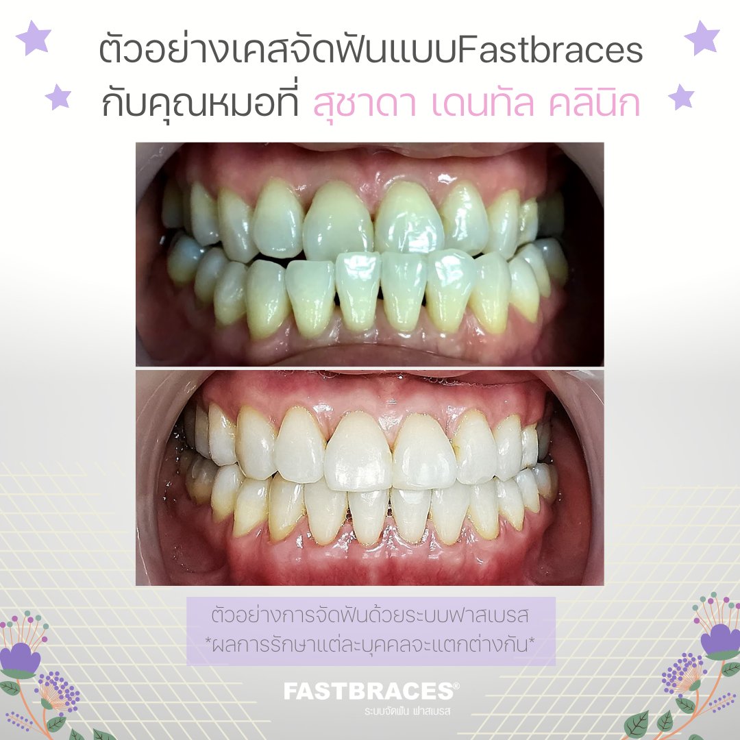 FastbracesAsia's tweet photo. สำหรับเพื่อนๆที่มีปัญหาแบบนี้..
👉#ฟันล่างคร่อมบน
👉กัดเส้นไม่ขาด
👉เคี้ยวไม่ละเอียด
👉อยากจบปัญหานี้ โดยที่ใช้เวลาไม่นาน 
.
⭐ #ระบบจัดฟันฟาสเบรส⭐
.
โดย สุชาดา เดนทัล คลินิก 🥰
.
#จัดฟัน #จัดฟันเร็ว #จัดฟันที่ไหนดี #อยากจัดฟัน #จัดฟันที่ดีที่สุด #จัดฟันใกล้ฉัน #คลินิกจัดฟัน https://t.co/1PZG2WESrx