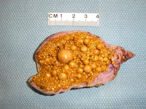 Жкб камни желчного пузыря. Как мни желчного пузыря. Питание при желчнокаменной болезни с острым холециститом. Билирубиновые камни в желчном. Желчекаменная болезнь холестериновые камни.