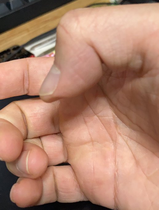 絵を描いたあと親指の形がしばらく変だからやはり異常なまでの筆圧がかかっている可能性ある。 