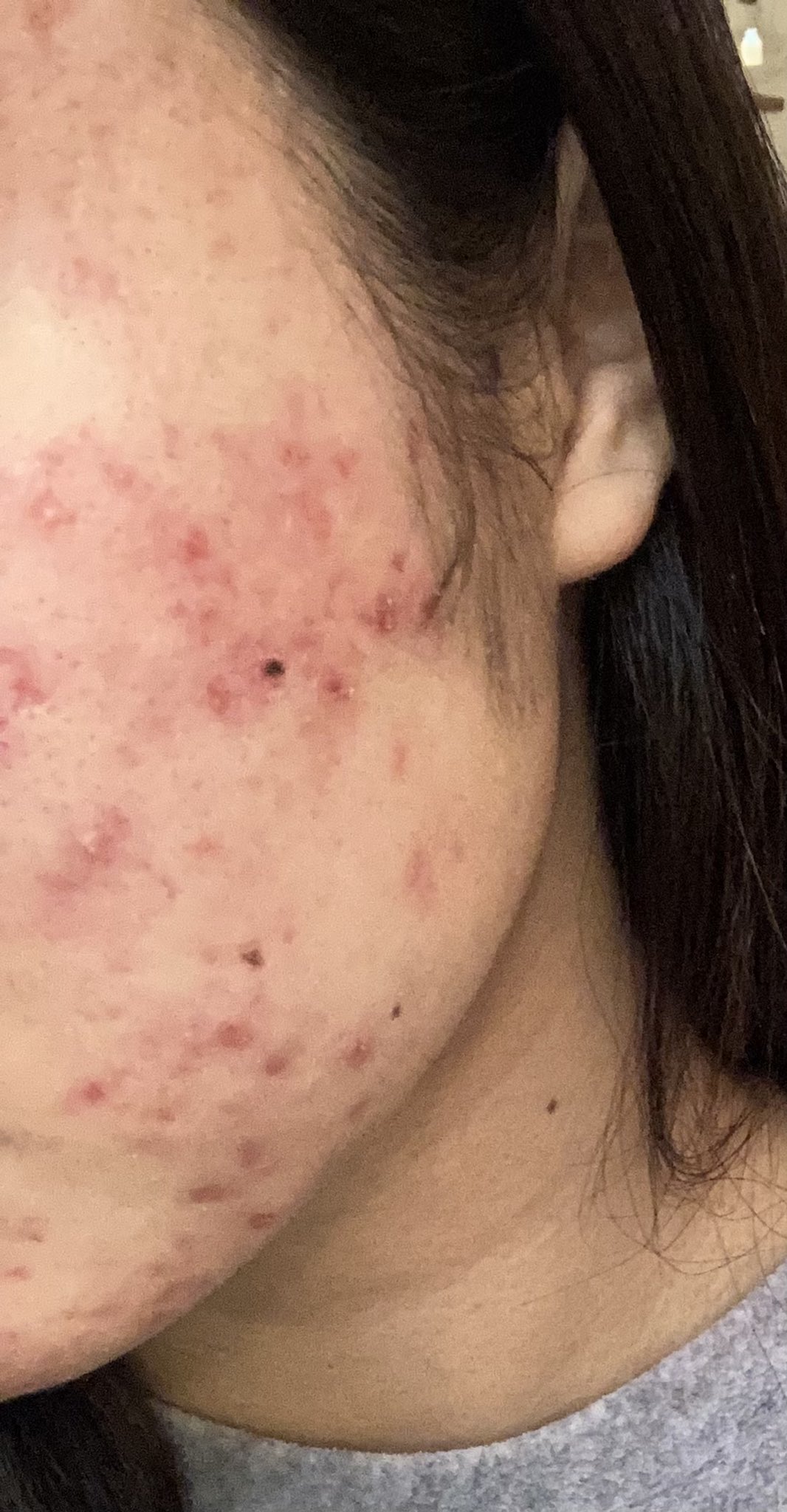 肌荒れ Loveisblind Twitter