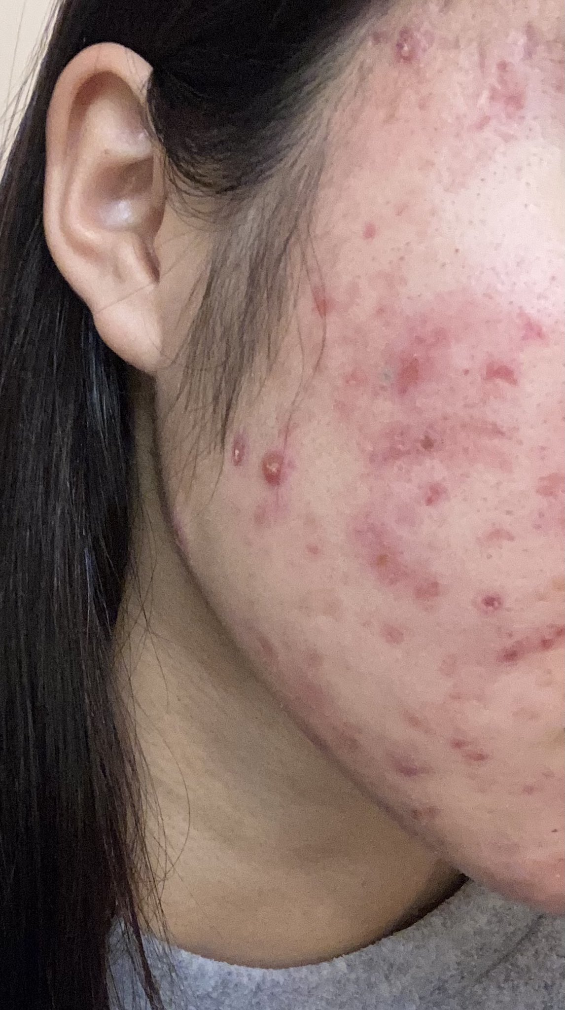 肌荒れ Loveisblind Twitter