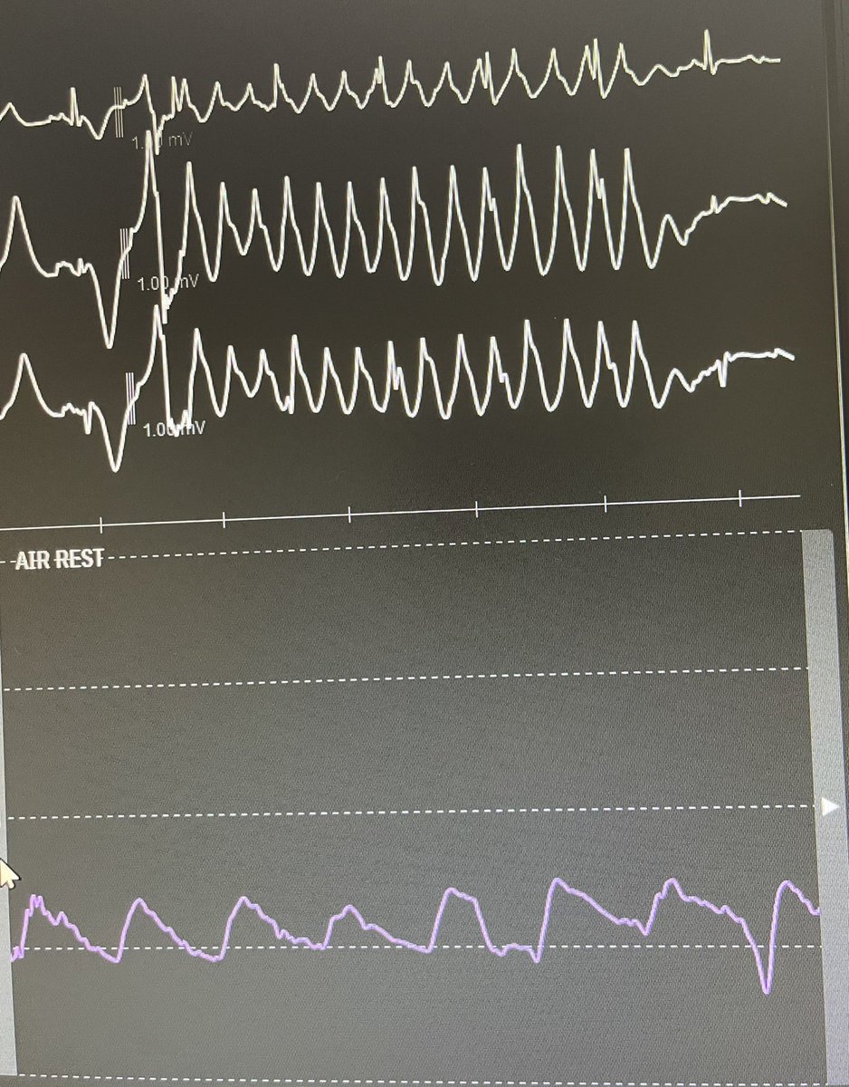 jedicath's tweet photo. Balloon non-dilatable. Successful @ShockwaveIVL lithotripsy. Two lithotripsy trains were followed by wide complex VT after the end of the shocks. Self terminated and stable #CardioTwitter https://t.co/5Q8owaVnbG