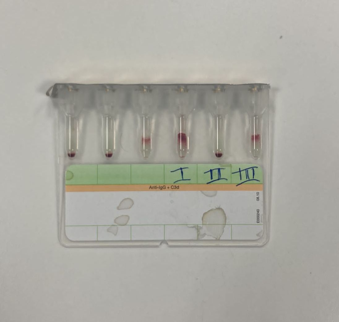 mer_501's tweet photo. ¿QUÉ TRANSFUNDIR ANTE UN ESCRUTINIO DE ANTICUERPOS IRREGULARES POSITIVO?
El Dr. Abel Dos Santos dará las claves en la 2º edición de #HematoBites Jornadas de urgencias hematológicas para residentes (y adjuntos!)
@HematoLaPaz
24/2 16 hs
Link de acceso:https://t.co/aFEi2EBRhL https://t.co/f3jluA8JKW