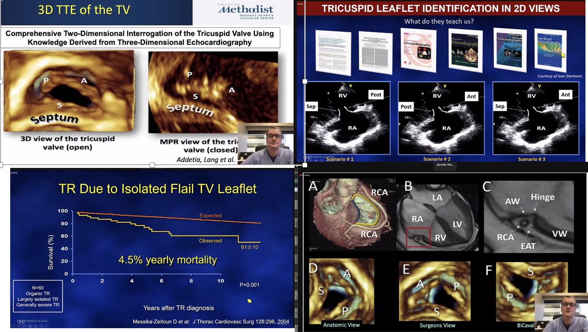Fantastic review of the not anymore forgotten Valve #EchoSOTA #echofirst 
✨Always identify the etiology&mechanism of TR
✨Limitations of identifying TV leaflets by 2D echo
✨TEE evaluation of TR has improved, and imaging expectations have increased!!!
