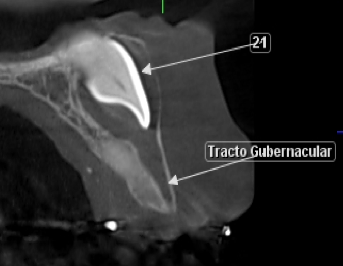 CIDEMImagen's tweet photo. CANAL GUBERNACULAR ASOCIADO A UN DIENTE RETENIDO.
Sociedad Venezolana de Radiología e Imagenología Dentomaxilofacial
Disponible en:
https://t.co/8gVB0rrsjc https://t.co/qUy5e6j090