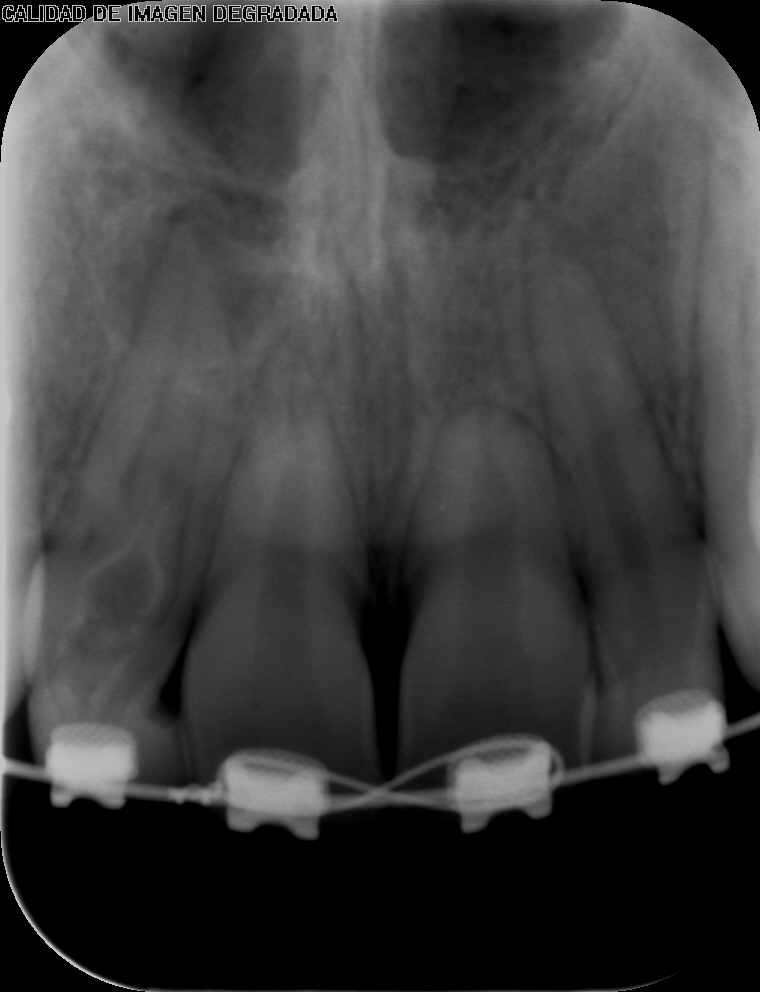 CIDEMImagen's tweet photo. La radiografía periapical permite observar el diente y el hueso alveolar adyacente, es indicada para valorar fracturas, morfología de  raíces y conductos radiculares, así como la presencia de lesiones periapicales. 
#radiology #cidem https://t.co/jMtMOZ1nj8