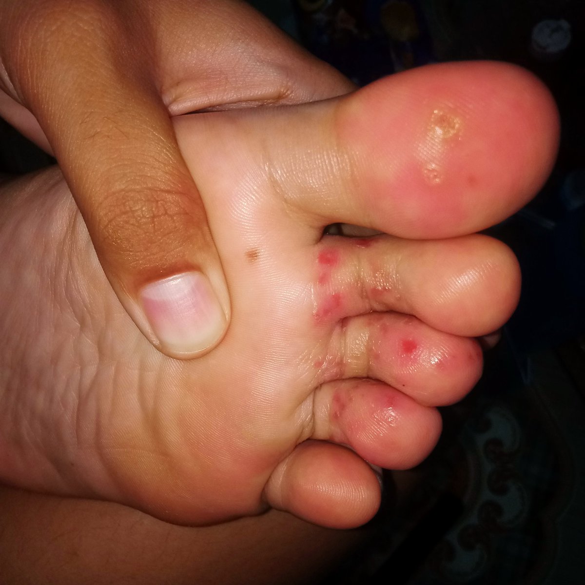 roesiepark's tweet photo. Kondisi kaki sebelah kiri, 21 Februari 2022

😭😭😭 https://t.co/TI9gHo8WNC