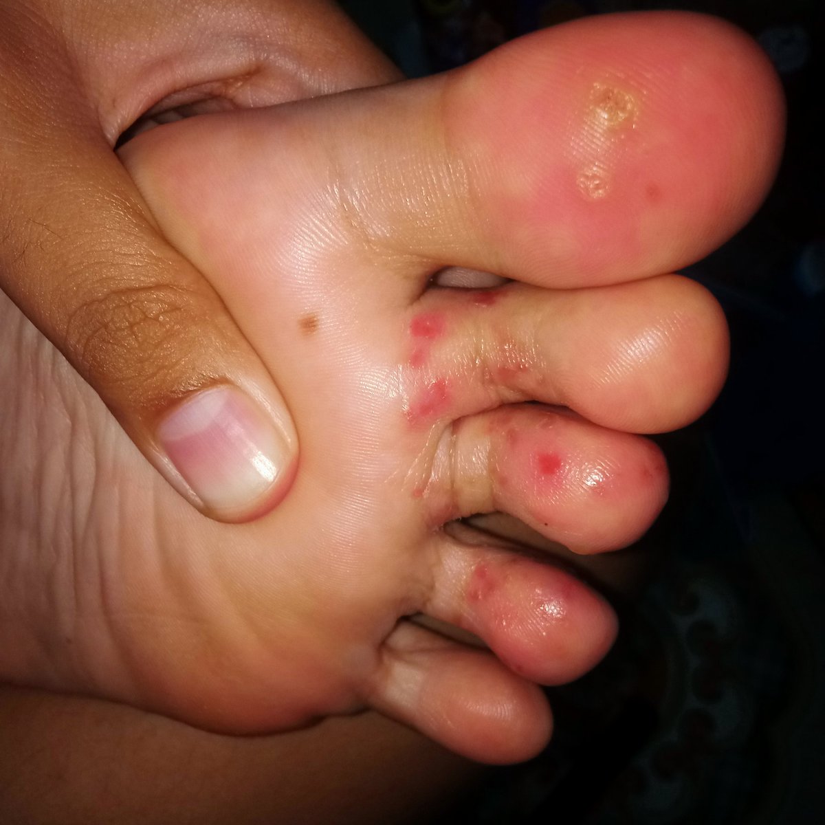 roesiepark's tweet photo. Kondisi kaki sebelah kiri, 21 Februari 2022

😭😭😭 https://t.co/TI9gHo8WNC