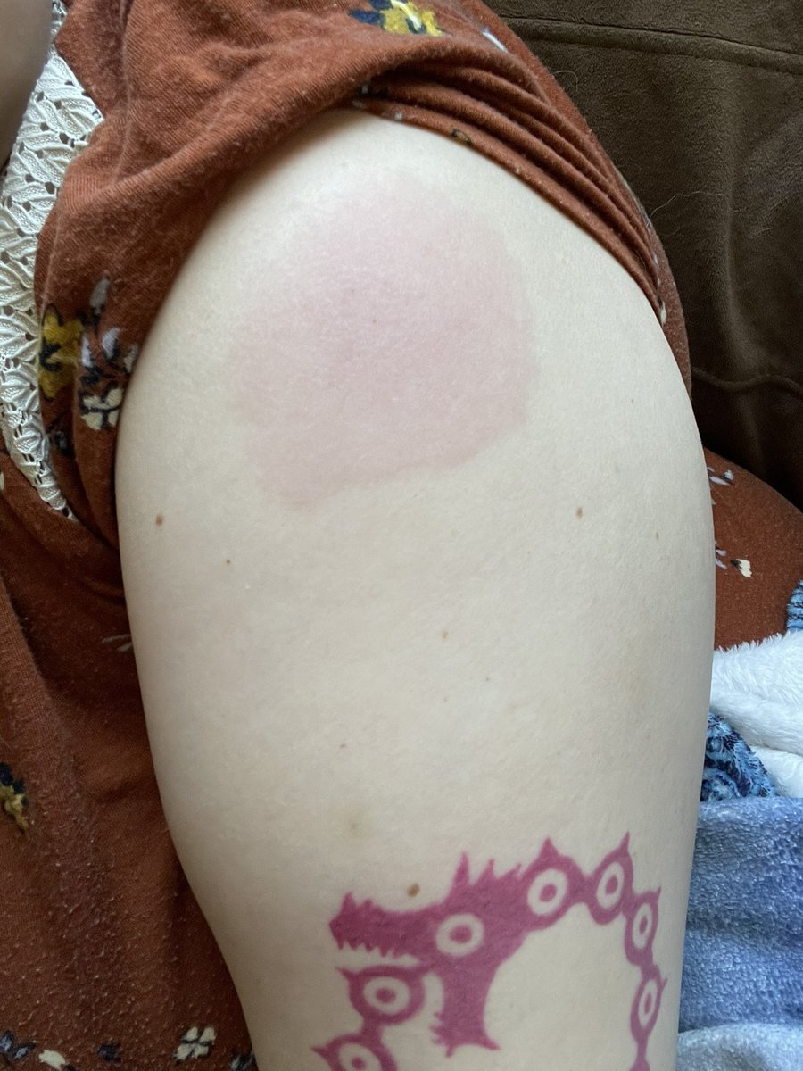 Nen_Tendou64's tweet image. Hmmm…I wonder where exactly I got my second Covid vaccine injected 🤔this is the site two days after getting it 😭 #hurtslikeabitch #healthcarelife #ifeelliketrash #gladimdonewithit #covidvaccine #vaccinated #sore #everythinghurts