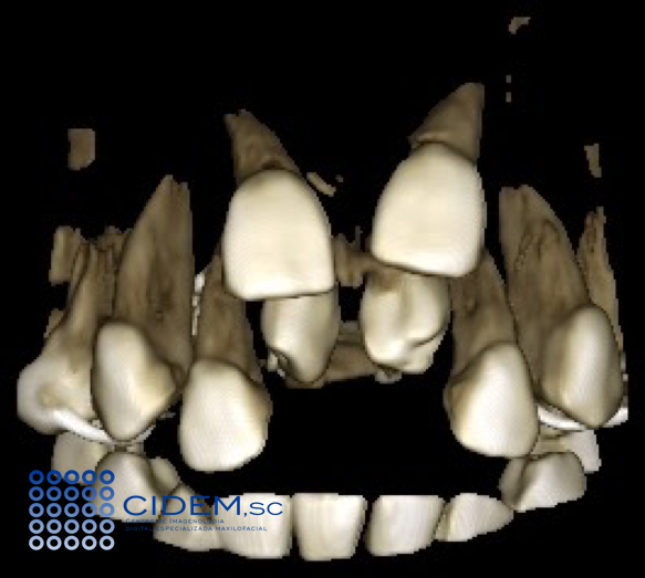 CIDEMImagen's tweet photo. ¡NUEVO! #CASORADIOGRAFICO
Disponible en nuestro BLOG: 
MESIODENS ASOCIADOS CON DENS INVAGINATUS
https://t.co/XhRaCI0Bum
¡COMPARTE!
#Cidem #Radiology https://t.co/h8IautH00y