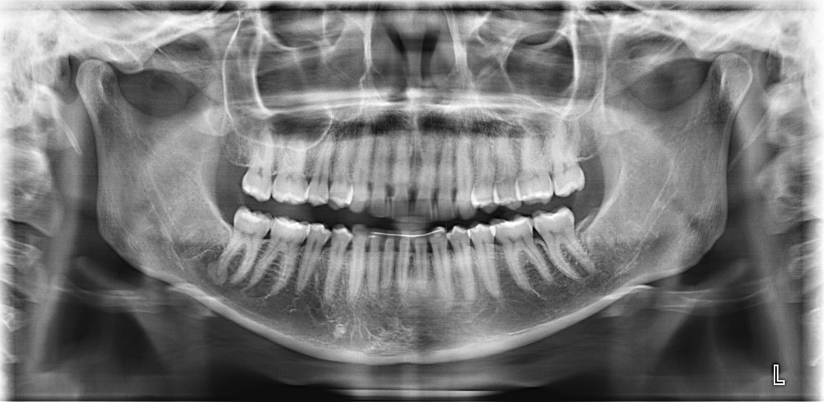 CIDEMImagen's tweet photo. La radiografía panorámica permite observar en una única imagen, ambos maxilares y los dientes. Constituye una importante  herramienta para la evaluación inicial del paciente. 
#radiology #cidem https://t.co/zqTBtqzQqy