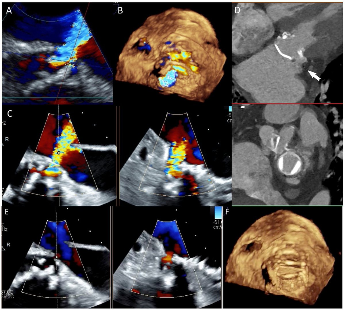 tiffchenMD's tweet image. Excellent review on multimodality #cvImaging of prosthetic valves by @selma_carlson @GilbertHabib @JonathonLeipsic @sarano_maurice @JoaoLCavalcante on assessing SVD, PPM, HALT, thrombus, pannus, PVL, &amp;amp; IE by #echofirst #yesCCT #whyCMR #cvNuc #ACCimaging

👉🏽bit.ly/3I82k1I