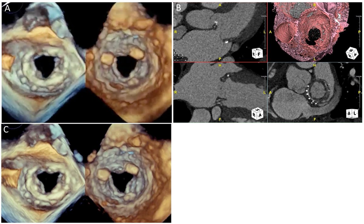 tiffchenMD's tweet image. Excellent review on multimodality #cvImaging of prosthetic valves by @selma_carlson @GilbertHabib @JonathonLeipsic @sarano_maurice @JoaoLCavalcante on assessing SVD, PPM, HALT, thrombus, pannus, PVL, &amp;amp; IE by #echofirst #yesCCT #whyCMR #cvNuc #ACCimaging

👉🏽bit.ly/3I82k1I