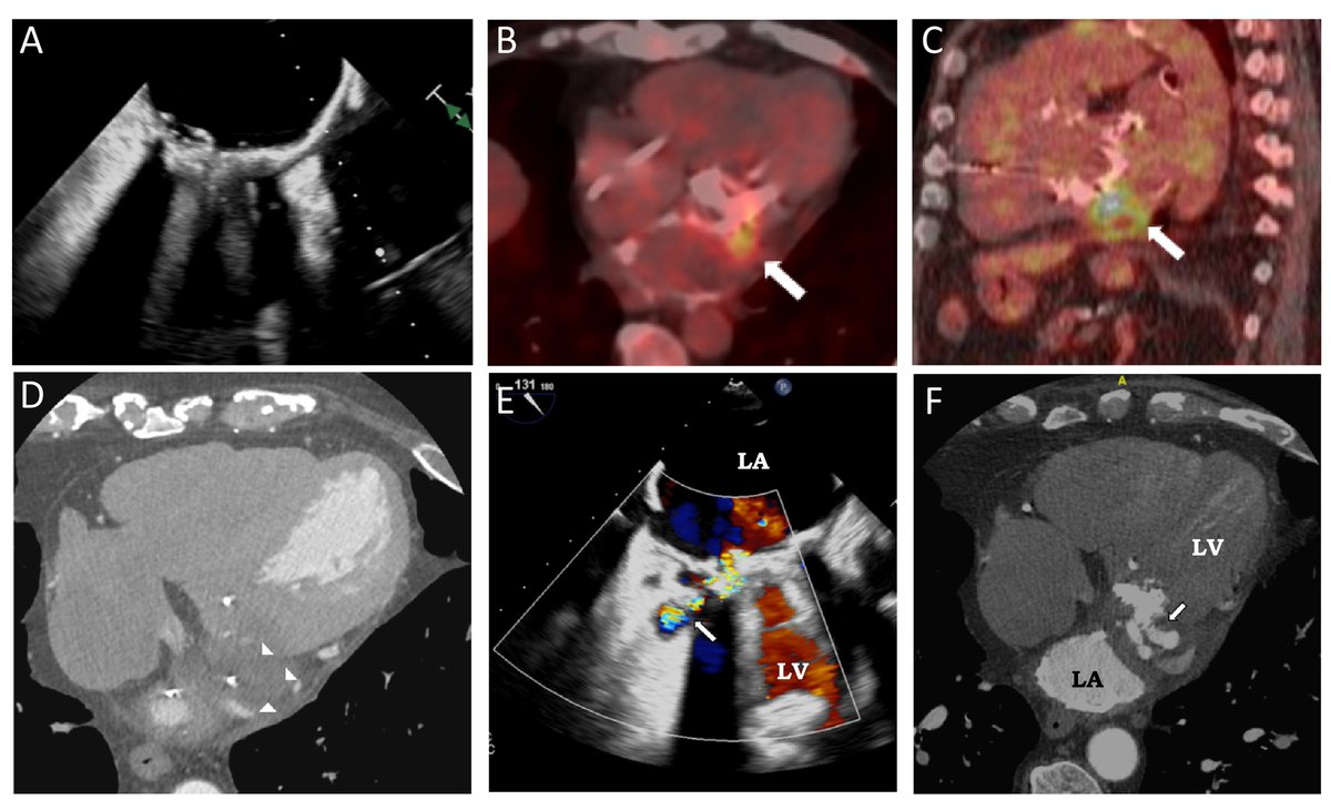 tiffchenMD's tweet image. Excellent review on multimodality #cvImaging of prosthetic valves by @selma_carlson @GilbertHabib @JonathonLeipsic @sarano_maurice @JoaoLCavalcante on assessing SVD, PPM, HALT, thrombus, pannus, PVL, &amp;amp; IE by #echofirst #yesCCT #whyCMR #cvNuc #ACCimaging

👉🏽bit.ly/3I82k1I