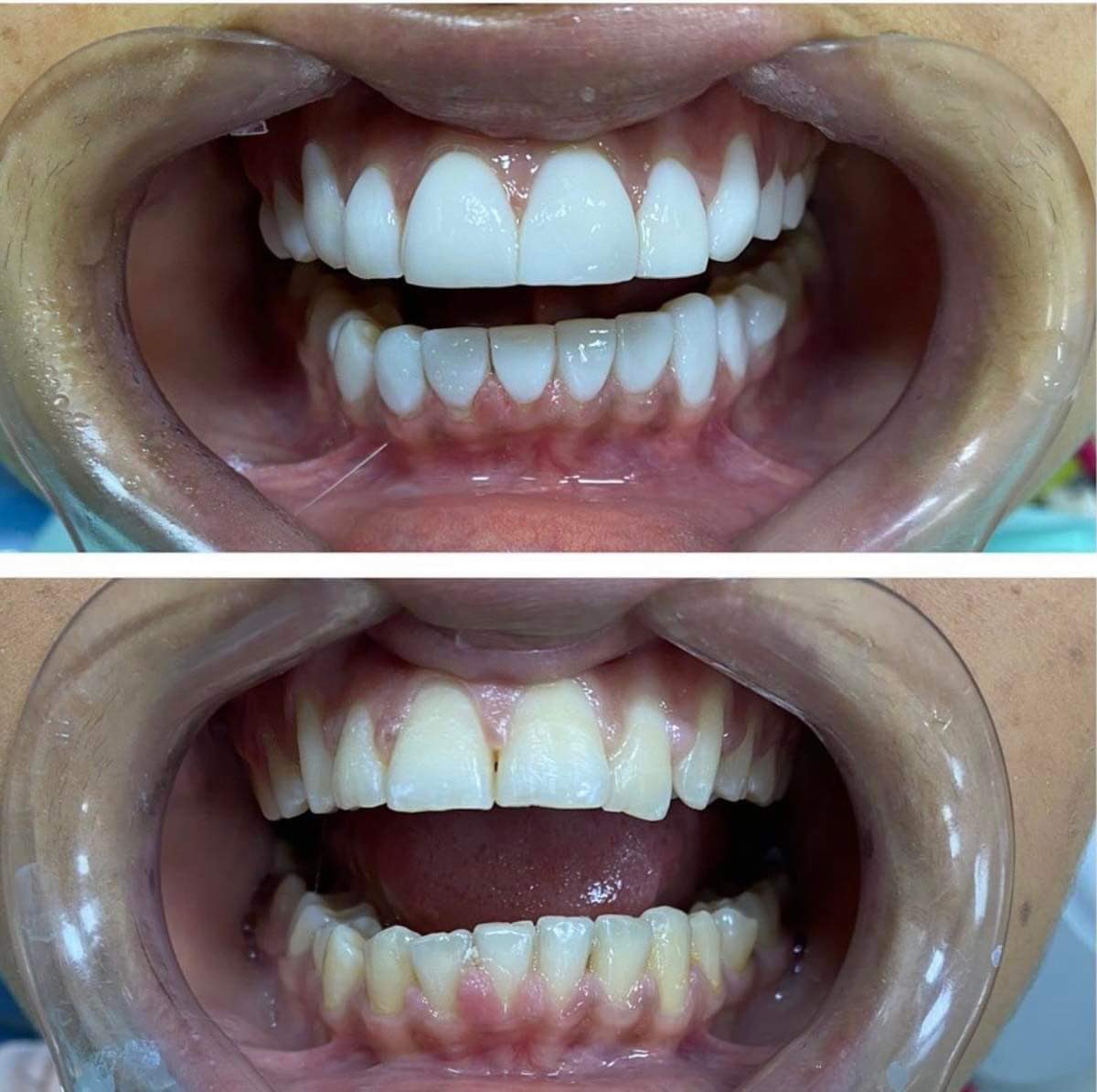 Binky_TheG's tweet photo. BUSS DOWN 20 piece 🧚‍♀️
#veneers #teethwhitening #travel https://t.co/zErArxUZk8
