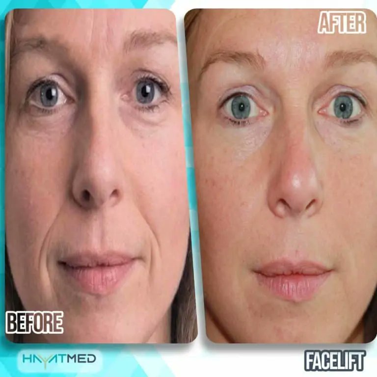 Hayatmedclinic's tweet photo. Are you looking for facelift surgery in Turkey? HayatMed is the best clinic that can achieve the looking which you dream of. Book an appointment now! https://t.co/1MfLoNWN9a
#facelift_surgery #plasticsurgery #hayatmed #turkey #faceliftturkey https://t.co/M6sff6V1Ox