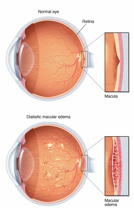 Diabetic macular edema (DME) is a complication of diabetes. People with type 1 or type 2 diabetes can develop DME. DME occurs when excess fluid starts to build up in the macula of the eye. The macula allows one to focus and see fine details.
#Diabeticmacularedema #optometry