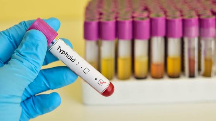 SA typhoid: ‘Contamination of municipal water is extremely unlikely to be the source’
National Institute for Communicable Diseases reported on clusters of #typhoid | enteric fever in #WesternCape + #NorthWest provinces, including possible infection source.
outbreaknewstoday.com/south-africa-t…