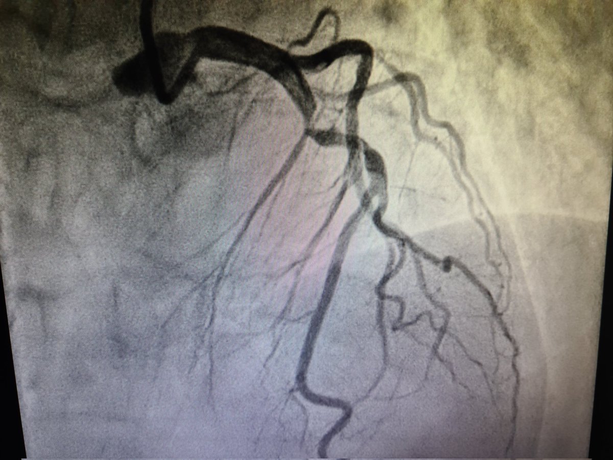Interesting case for discussion- 55yrs female,  csa   angio lad significant lesion.. stented after aggressive predilatation..cag image