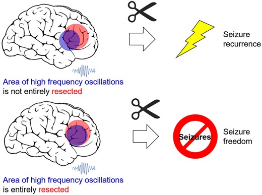 braincomms's tweet photo. Dimakopoulos et al. applied automated HFO detection on iEEG from patients that underwent epilepsy surgery. The analysis is blind to clinical outcome and achieves good prediction of seizure outcome. https://t.co/acBrjoE86L @Unispital_USZ @UZH_en @DimakopoulosVas @SarntheinJ https://t.co/lMCeIBitcZ