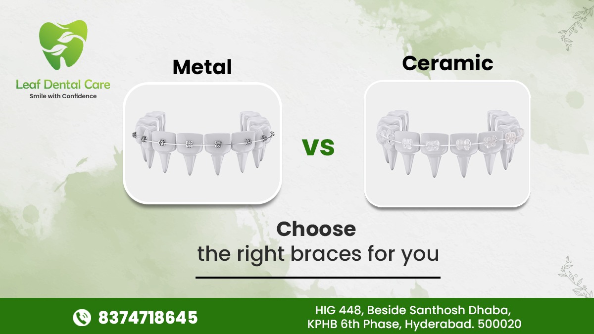 Are you confused with the selection of Braces?

For more information, book an appointment @Leaf_DentalCare

#MetalBraces #CeramicBraces #Braces #Dentistry #Hyderabad #Telangana #KPHB #LeafDental #LeafDentalCare