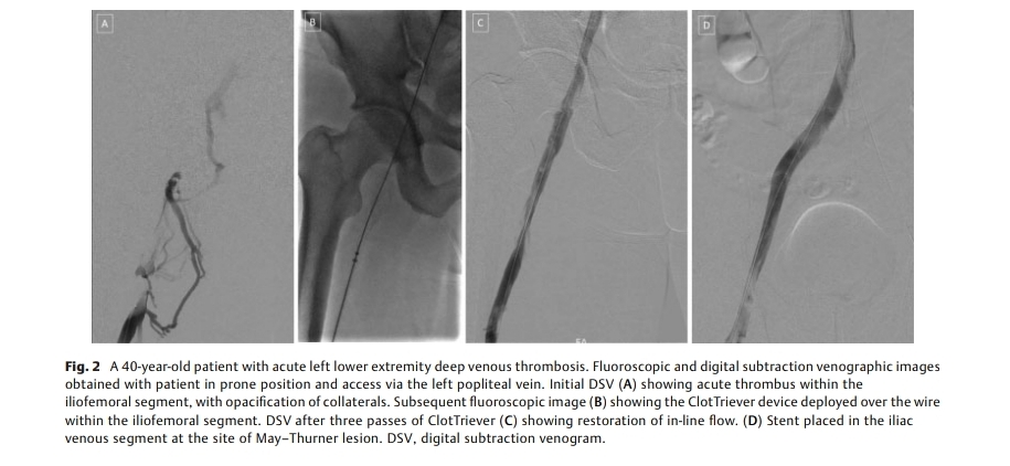 The Arab Journal of Interventional Radiology (@arabjir) on Twitter photo #AJIR Single-Session Mechanical Thrombectomy of Lower Extremity Deep Venous Thrombosis Using the ClotTriever System: A Single-Institution Experience
<a href="/Anuj_MalhotraMD/">Anuj Malhotra MD, FSIR, RPVI</a> <a href="/pairsmedia/">PAIRS</a>
Abstract: thieme-connect.com/products/ejour…
HTML: thieme-connect.com/products/ejour…
PDF: thieme-connect.com/products/ejour… #AJIR Single-Session Mechanical Thrombectomy of Lower Extremity Deep Venous Thrombosis Using the ClotTriever System: A Single-Institution Experience
<a href="/Anuj_MalhotraMD/">Anuj Malhotra MD, FSIR, RPVI</a> <a href="/pairsmedia/">PAIRS</a>
Abstract: thieme-connect.com/products/ejour…
HTML: thieme-connect.com/products/ejour…
PDF: thieme-connect.com/products/ejour…