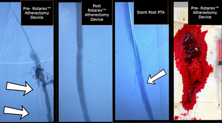 Todd_BDPI's tweet photo. Rotarex™ Atherectomy Device case by Dr. Ravikumar. Great results! #RemoveWithRotarex System

Not for use in the cardiopulmonary, coronary, carotid, cerebral, renal or venous vasculature. Safety info: https://t.co/k57QpcN1mG https://t.co/71F6Aglykz