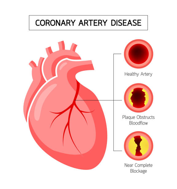 CADAwareness's tweet photo. 18.2 million adults age 20 or older have Coronary Artery Disease. Coronary Artery disease is the most common heart disease in America, killing 360,900 people in 2019. https://t.co/IVHmbrKUtW