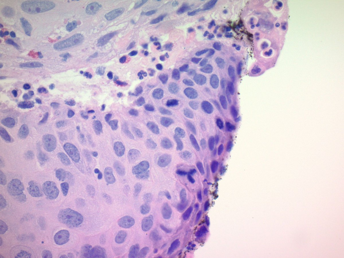 DelandWeyrauch's tweet photo. The famous tripolar mitosis of cervical intraepithelial neoplasia. This finding is automatic HSIL.

#PathTwitter #PathMatch22 https://t.co/Zixock4egW
