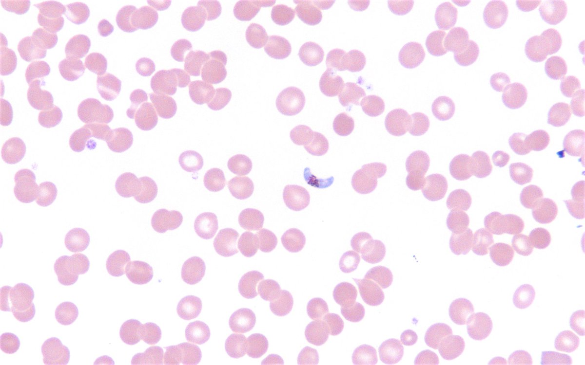 SCherianMicro's tweet photo. Monday Microbe! 🔬This was spotted in the peripheral smear of an adult patient recently returned from West Africa. What are you seeing here? 🦠Poll below⬇️ #MicroRounds #ClinMicroLab https://t.co/6HsdTcPcvQ