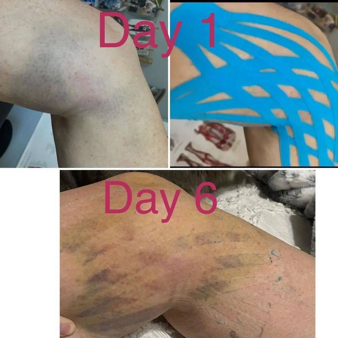 KinesioTape's tweet photo. #Repost @performancesolutionspt I can’t resist the opportunity to tape a bruise, whether or not that is what you’re here for. #kinesiotape #kinesiotaping #bruisehealing #cktp #performancesolutionspt #dontaskhowthishappened #painrelief #bruise #healing #kinesio #tapewithwisdom https://t.co/JWCMFYz4Pl