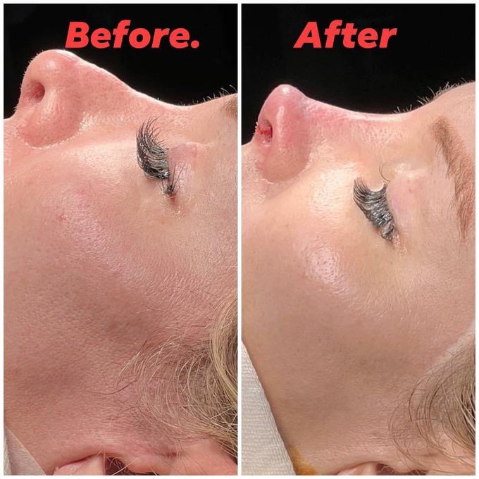 Sooo this happened &hellip; what do you all think ? #revisionrhinoplasty https://t.co/RVdbpkhvEw<a href="/tag/revisionrhinoplasty"class="tags">#revisionrhinoplasty</a>
