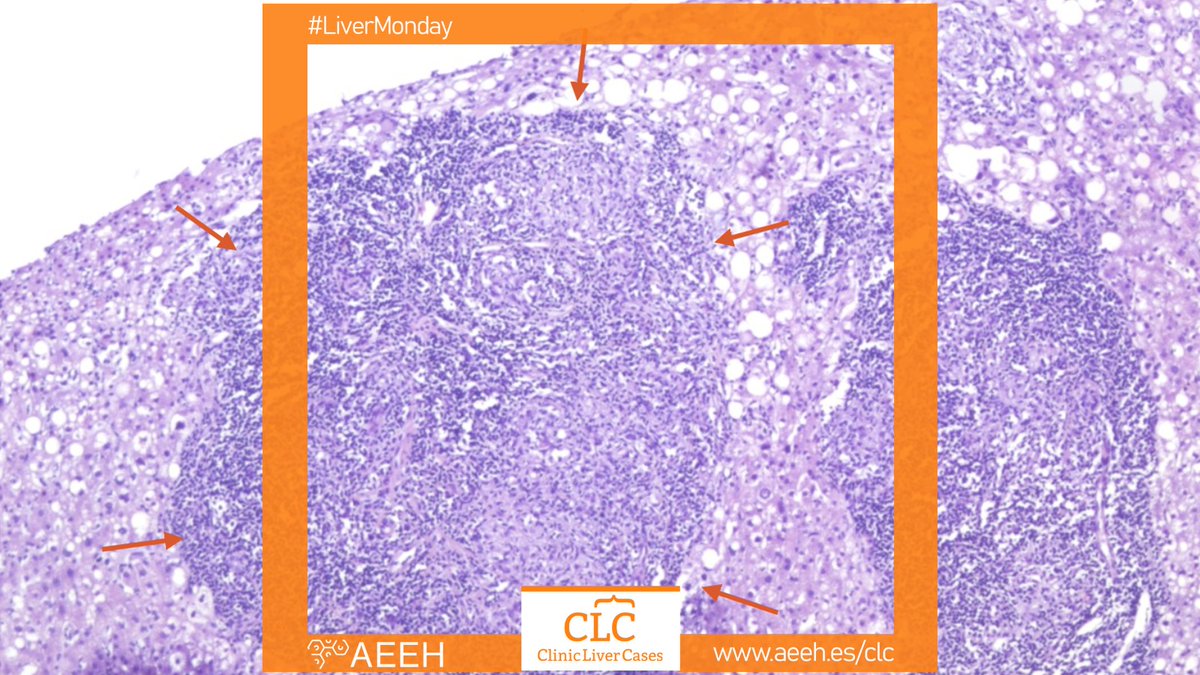 Juan Turnes (@jturnesv) on Twitter photo 👋 Hey my #livertwitter & #LiverPath friends, take a look to a new free platform bit.ly/3H7NC9M to learn, share and engage on liver diseases & liver pathology
👨👨👧 Designed by <a href="/livercases/">ClinicLiverCases</a> and endorsed by <a href="/AEEHLiver/">Asociación Española para el Estudio del Hígado</a>
🧠 1 new challenge every #LiverMonday. Join us! 👋 Hey my #livertwitter & #LiverPath friends, take a look to a new free platform bit.ly/3H7NC9M to learn, share and engage on liver diseases & liver pathology
👨👨👧 Designed by <a href="/livercases/">ClinicLiverCases</a> and endorsed by <a href="/AEEHLiver/">Asociación Española para el Estudio del Hígado</a>
🧠 1 new challenge every #LiverMonday. Join us!