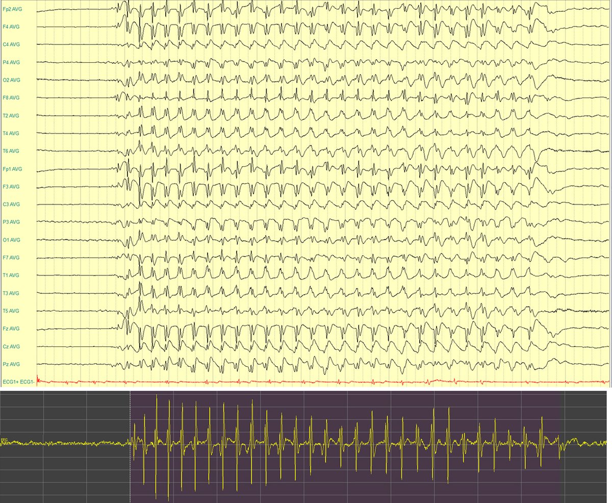 EpilepsiaJourn's tweet photo. Automated detection of absence seizures using a wearable EEG device: a phase‐3 validation study and feasibility of automated behavioral testing https://t.co/l671QrjONa 

#epilepsy #absenceseizure #wearbledevices #artificialintelligence @IlaeWeb @WileyNeuro @yesILAE https://t.co/V0WmHGGMAo