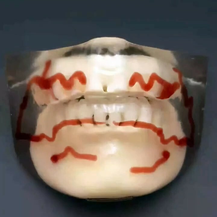 3dheals's tweet image. #repost @replicare3d EM BREVE: Simulador para procedimentos estéticos nos lábios. 

#preenchimentolabial #acidohialuronico #harmonizacaofacial #replicare #3dprinting #preenchimentofacial #fiosdesustentacao #esteticafacial #botox #cirurgiaplastica #dermat… instagr.am/tv/CaQVfe_DMuS/