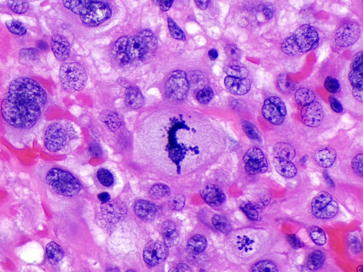 So-called ‘seahorse’ mitosis - must be a sign … 

#histopathology #HandE #PathArt