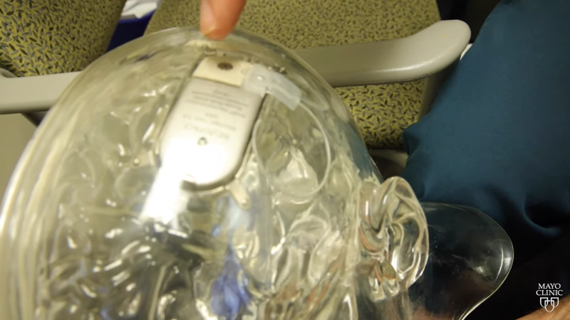 SFLReporter's tweet photo. What Is A ‘Brain Pacemaker?’ (Video)
https://t.co/ybKLFqjuRH
#SFR #MayoClinic #BrainPacemaker #Epilepsy https://t.co/CLhakRPToe