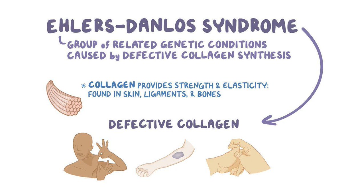 jclinicalmedres's tweet photo. Ehlers-Danlos syndrome, also called EDS, elastic skin is a group of inherited disorders that mostly affect the skin, joints, and blood vessels.
Ehlers-Danlos syndrome affects connective tissue, primarily the skin, joints, and blood vessel walls.
#EhlersDanlossyndrome #elasticskin https://t.co/iYmtJuuiK5