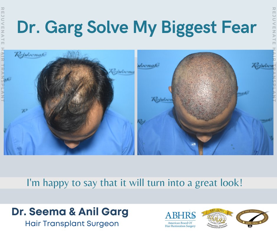 تويتر \ Rejuvenate Hair Transplant Centre على تويتر: تويتر \ Rejuvenate Hair Transplant Centre على تويتر: