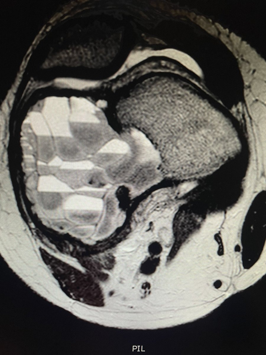 gotzon_i's tweet photo. Gorgeous fluid-fluid levels in a case of GCT with ABC component
#mskrad #radres https://t.co/Pa8eapjbUm