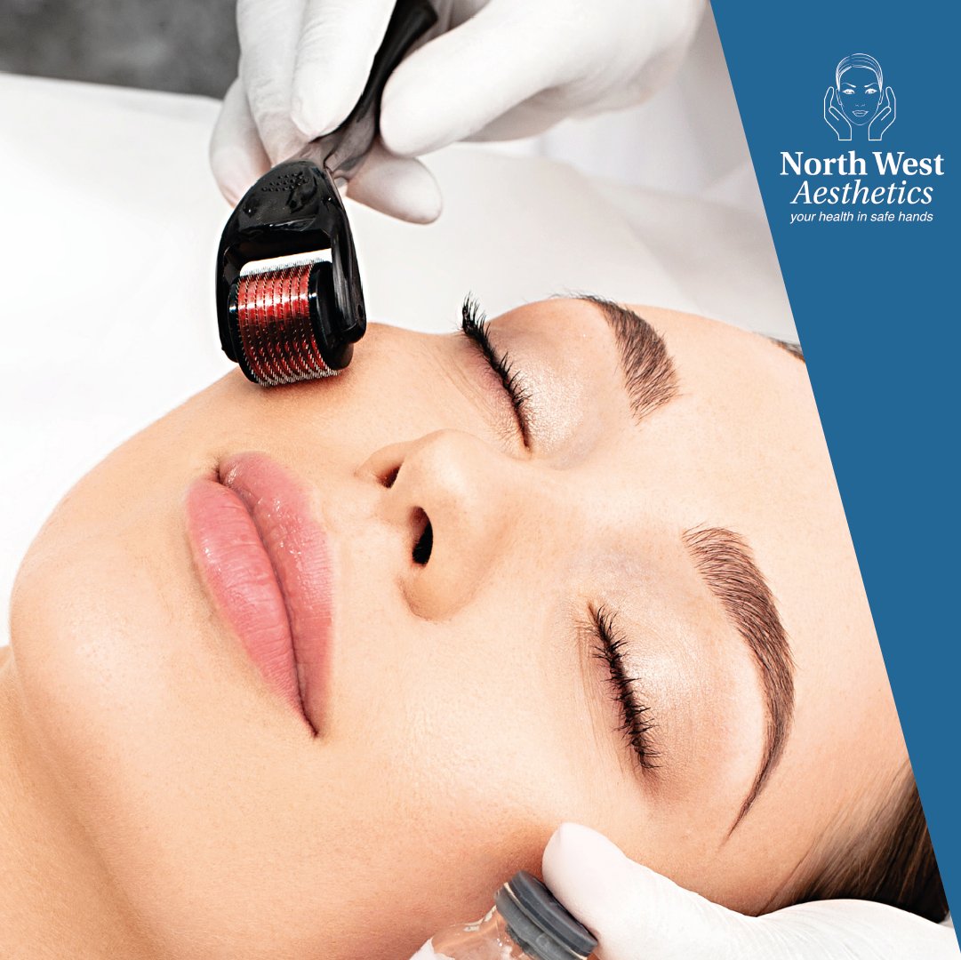 Diminish #FineLines, #AcneScarring and #Hyperpigmentation with #Dermaroller Treatments at North West Aesthetics. Micro-injuries stimulate the body’s natural healing response, improving the texture and tone of the #skin. Call #NorthWestAesthetics to book your appointment today.