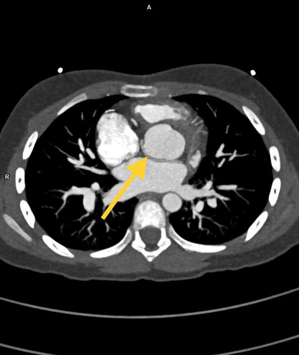 Natisha555's tweet photo. Post arterial switch in D TGA
Pulmonary trunk anterior to aorta with RPA and LPA draping over aorta. Also anomalous origin of Left circumflex artery from RCA(yellow arrows)

#radiology #cardiovascular #cardiacct #chd #MedTwitter https://t.co/alcedZOKza