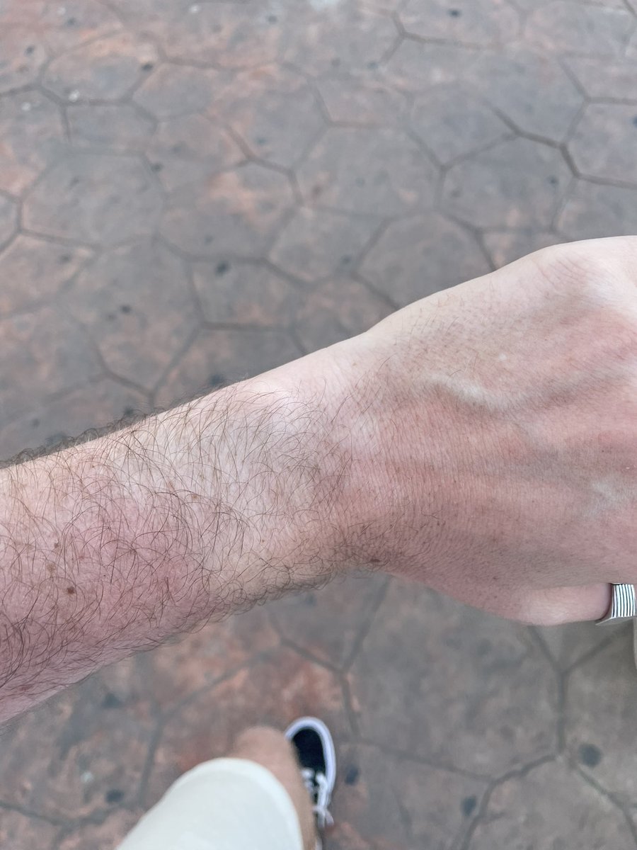 I’ll never forget the time now, my watch is burnt in my arm! 😂