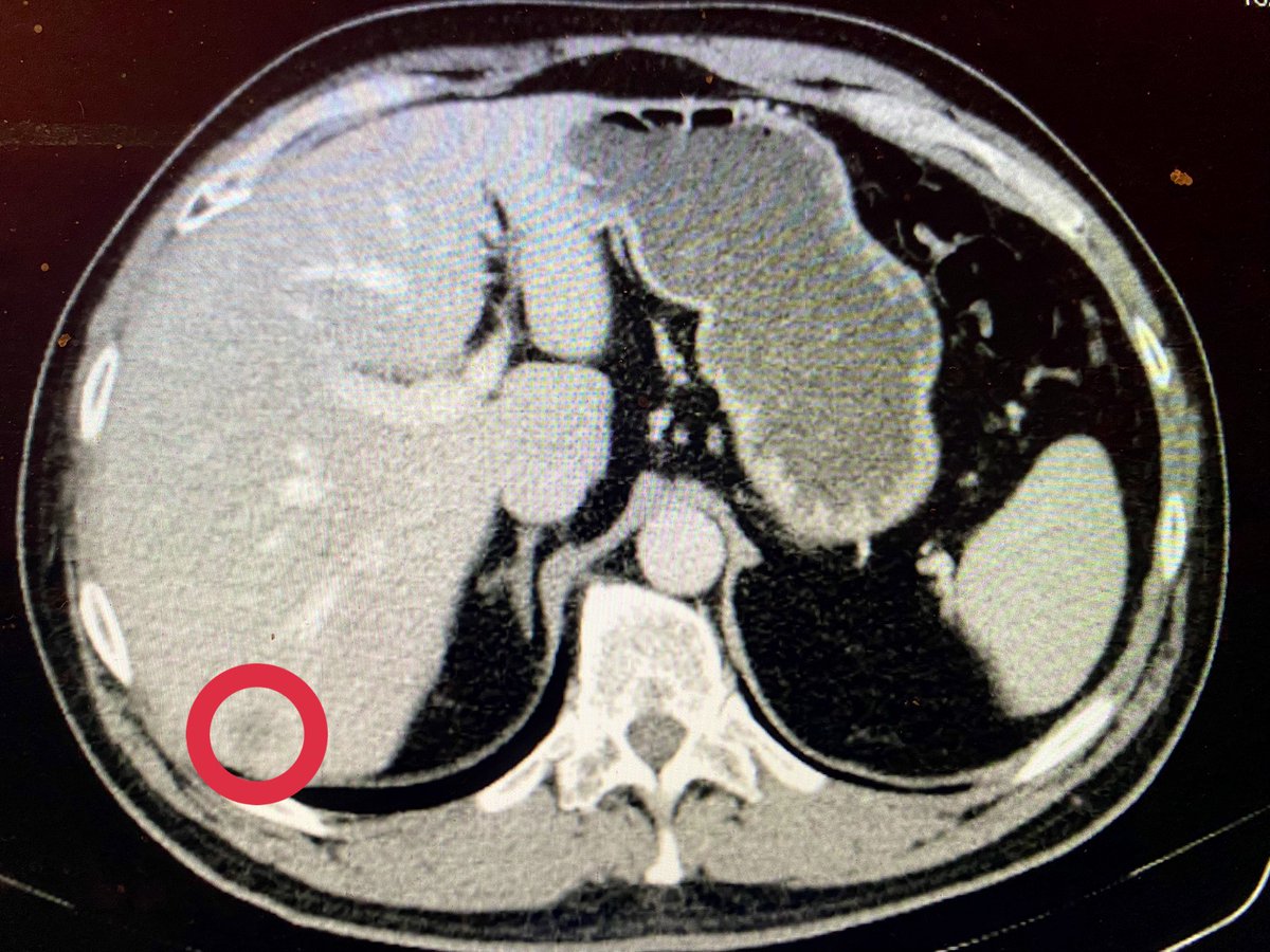 Hbp_EgLleida's tweet photo. VI-VIIcolorectal metastasis:robotic parenchymal-sparing hepatectomy/ICG24h before surgery/20degrees left tilt position/auxiliary port btw 1 and 2 forCUSA transection. How about your approach? @HpbMar @IelpoB @VMolina_82 @seccionhbpaec @fpa_que @hpb_so @santiazagra @Cesar_Ginesta https://t.co/NKAhMwbBq9